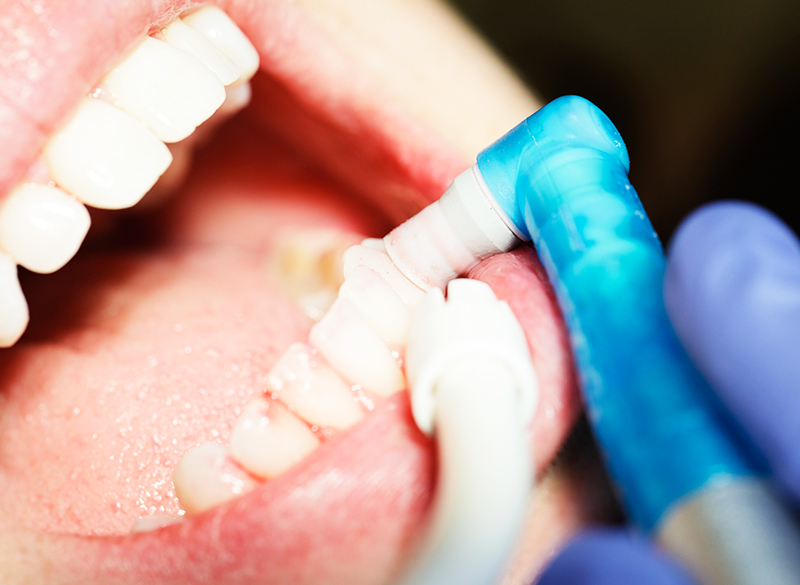 予防・クリーニング