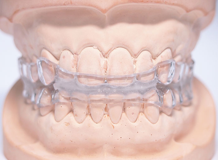 咬合治療でのマウスピースの活用